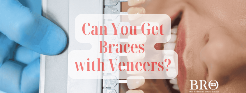 Can you get Braces on Veneers
