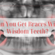 Can You Get Braces With Wisdom Teeth - GoToBro