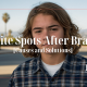 White Spots After Braces - Bill Redmond Orthodontics