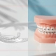 Braces or Invisalign for Teens How Parents Can Decide - Bill Redmond Orthodontics